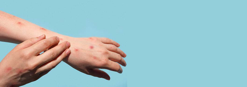 monkeypox disease